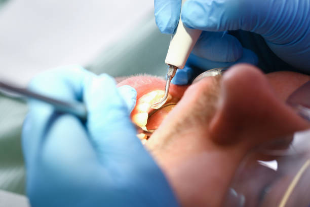 Best Chipped Tooth Repair Near Me  in Holland, TX